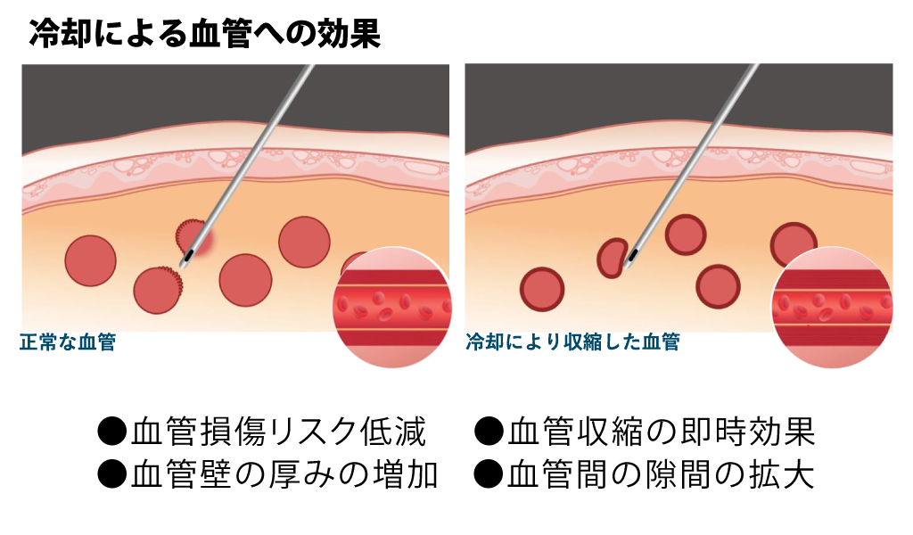 冷却による血管への効果