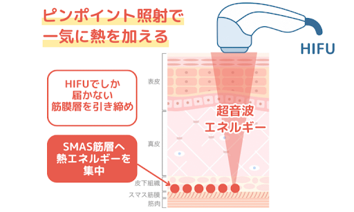HIFUのしくみ