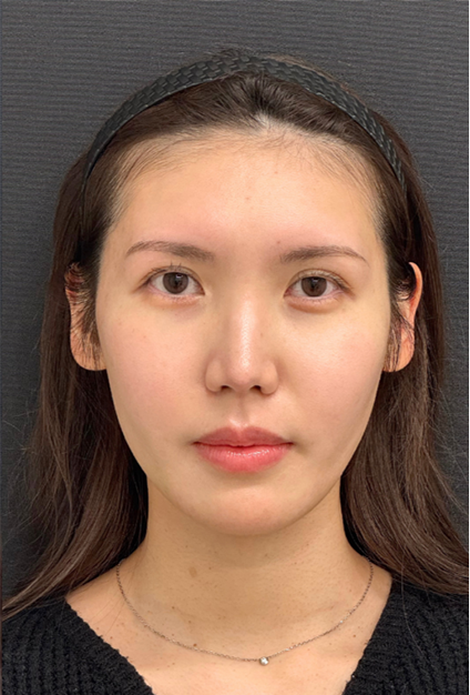 case1_after01
