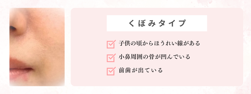 くぼみタイプのほうれい線