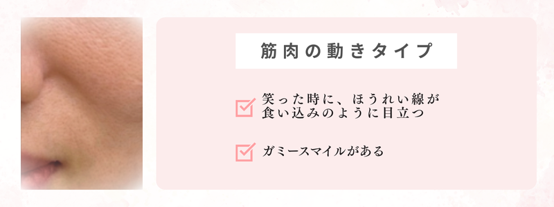 筋肉の動きタイプのほうれい線