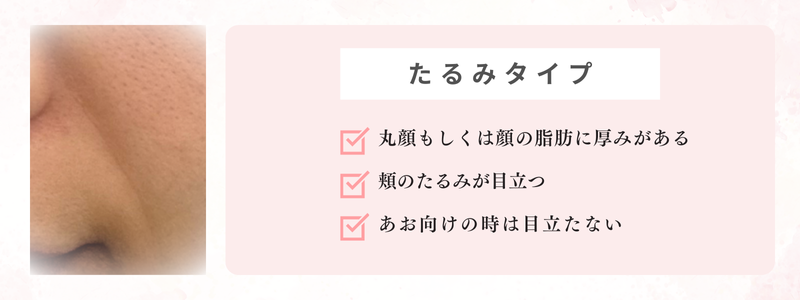 たるみタイプのほうれい線