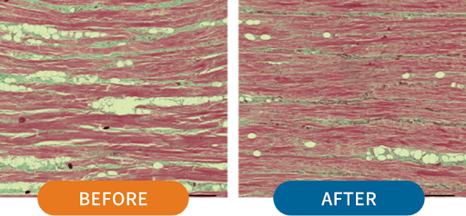 HIFESによる表情筋への効果