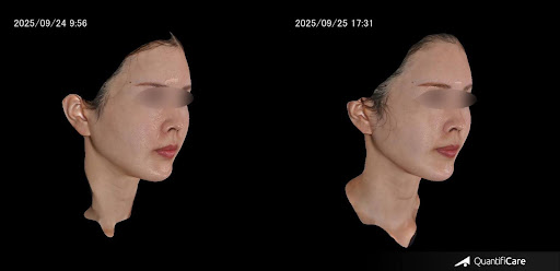 エムフェイス施術ビフォーアフター