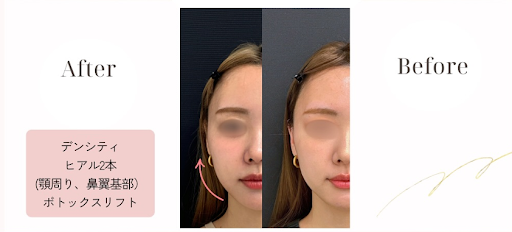 RF施術ビフォーアフター