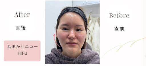 HIFU施術ビフォーアフター