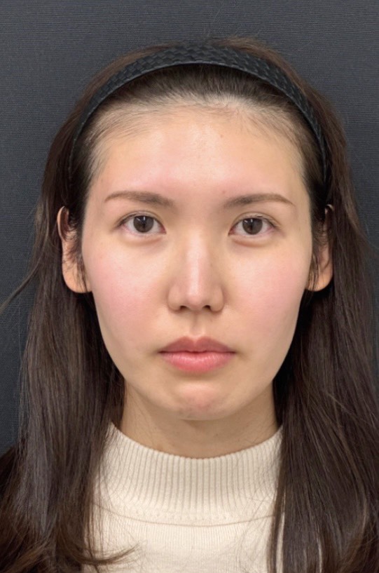 こめかみに影の症例