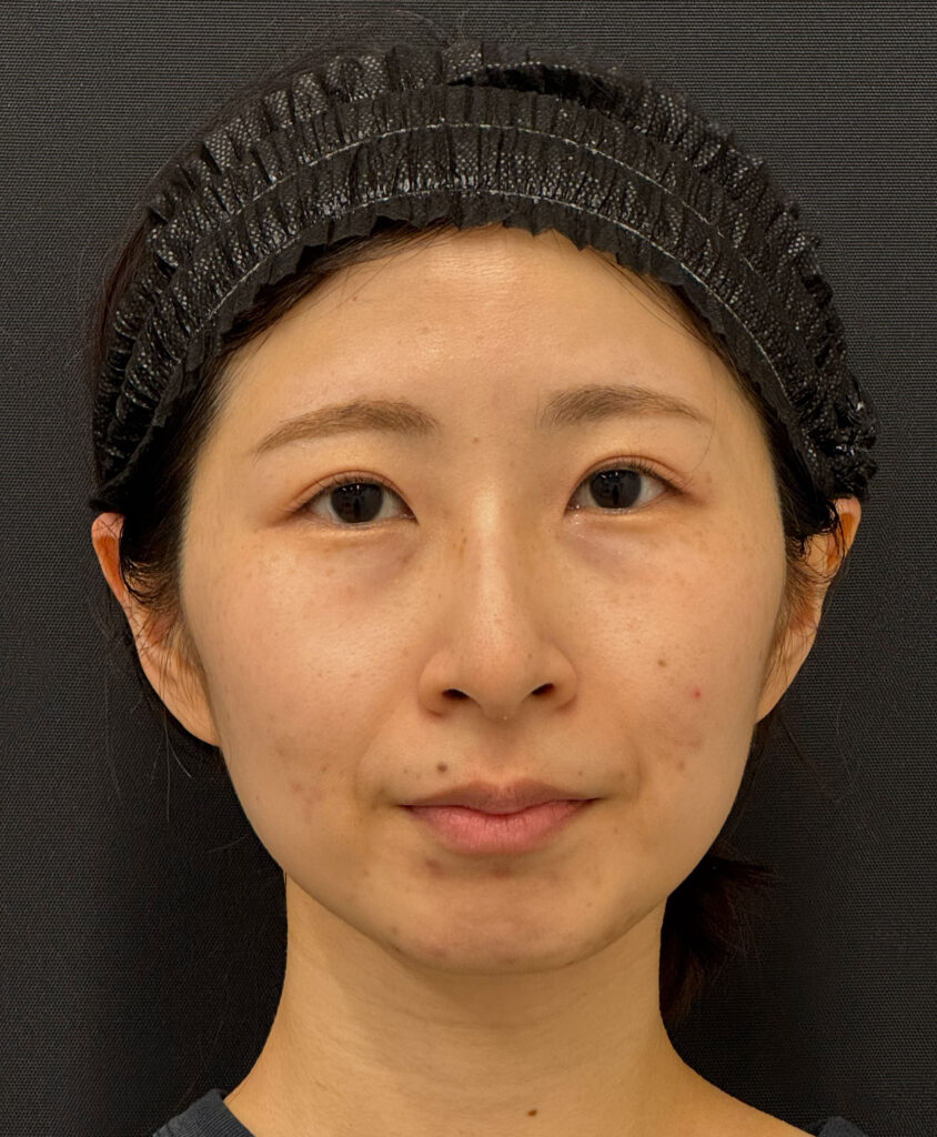 頬骨の下が凹んでいる症例