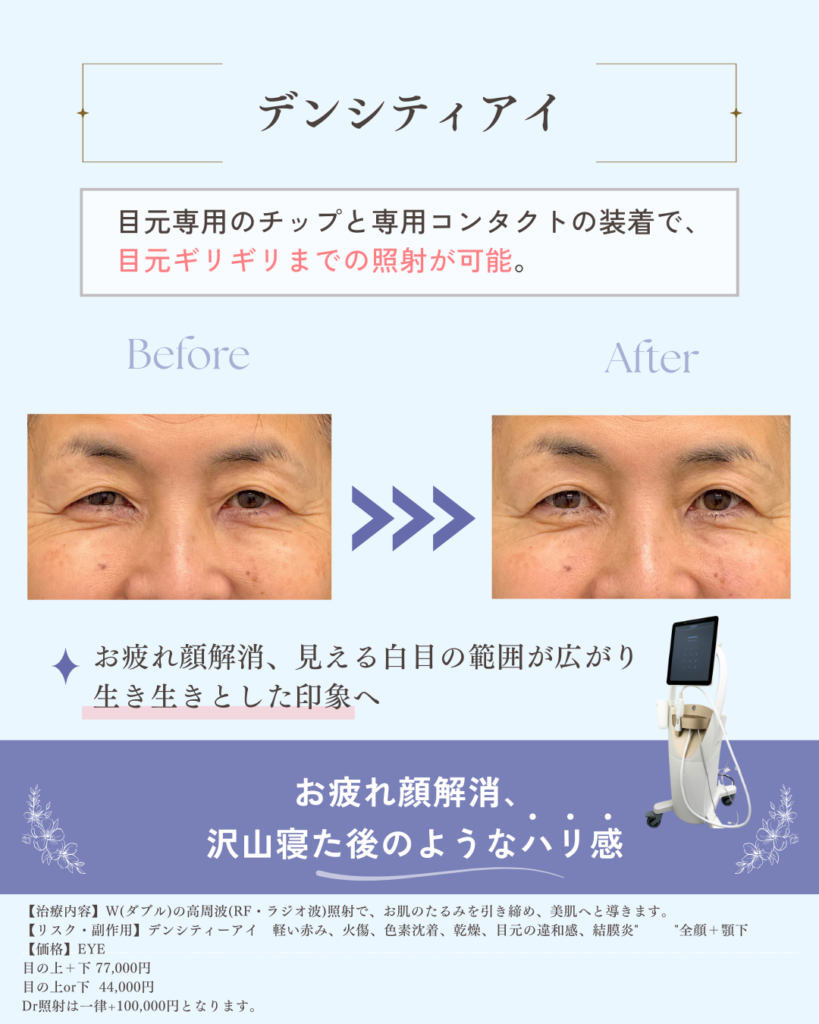 ココンベルのデンシティアイ