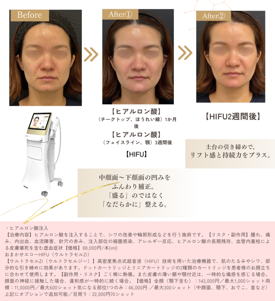 ヒアルロン酸注入とHIFUのコンビネーション施術の症例