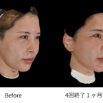 エムフェイス症例
