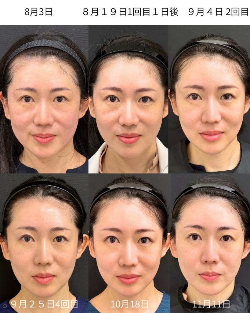 山本しおり院長のエムフェイス症例